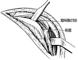 切开复位术图片