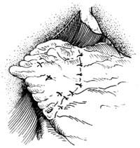 胆囊十二指肠吻合术图片