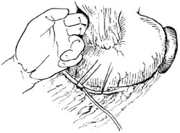 肝动脉插管术图片