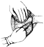 腹膜外剖宫产术图片