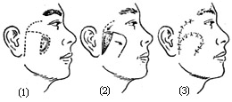 颊部组织缺损修复术图片