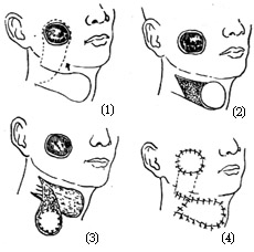 颊部组织缺损修复术图片